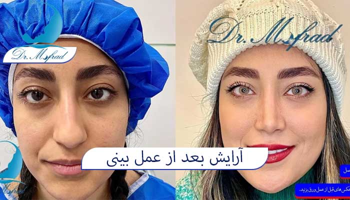 لیزر موهای صورت بعد از جراحی بینی
