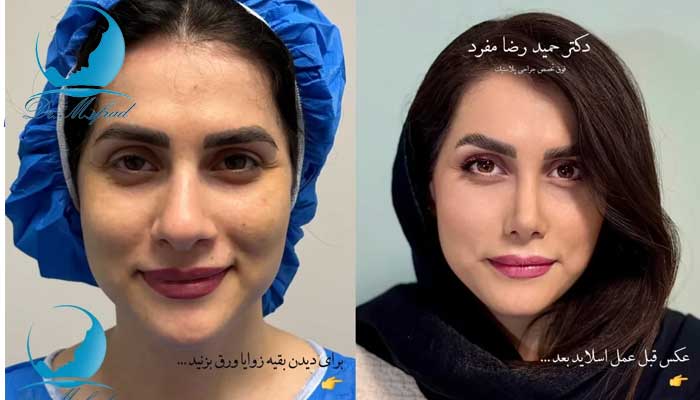 تکنیک های غیر جراحی نوک بینی