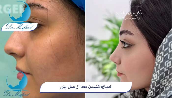 آیا خمیازه‌زدن زودهنگام بعد از عمل بینی خطرناک است؟