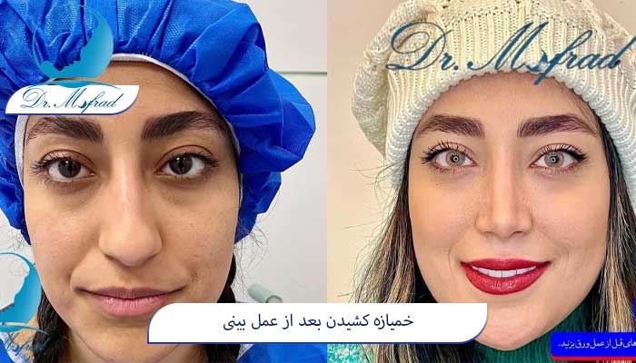 اثرات خمیازه کشیدن بر روی بینی بعد از انجام عمل