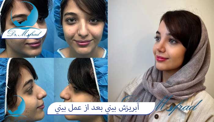 علت آبریزش بینی بعد از عمل 