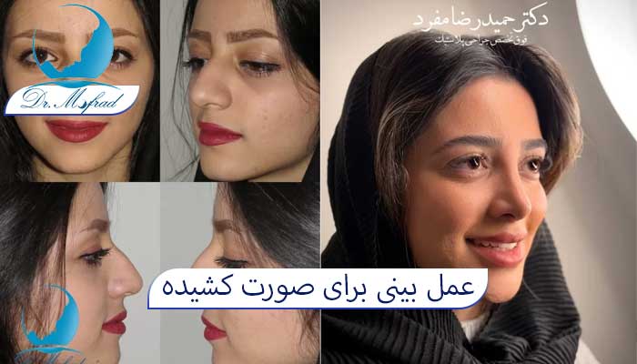 معایب جراحی بینی صورت کشیده