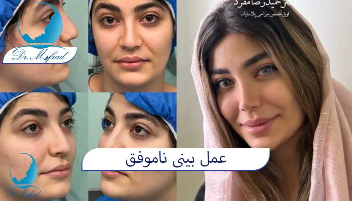 علل عمل بینی ناموفق