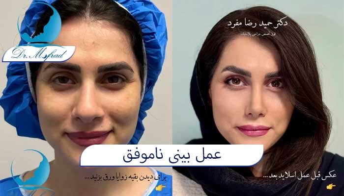 علت عمل بینی ناموفق