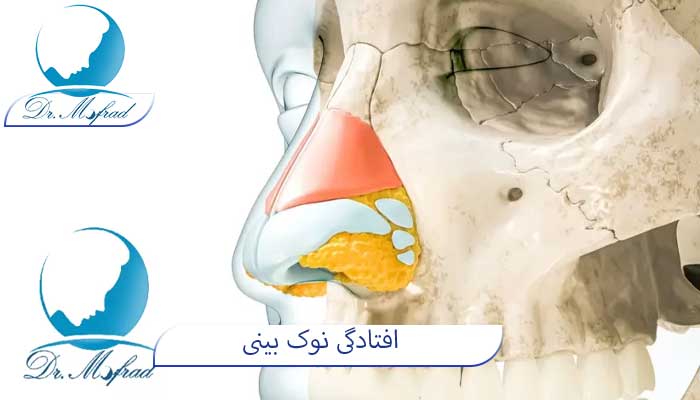 نوکی بینی افتاده چیست؟ 
