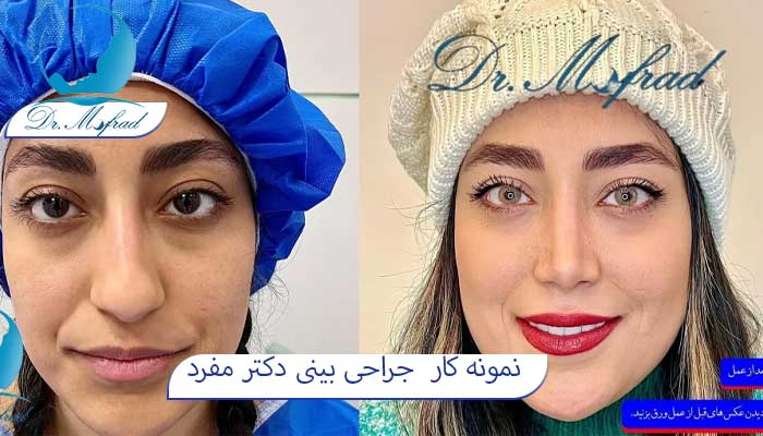 تکنیک‌های غیرجراحی برای بالا بردن نوک بینی