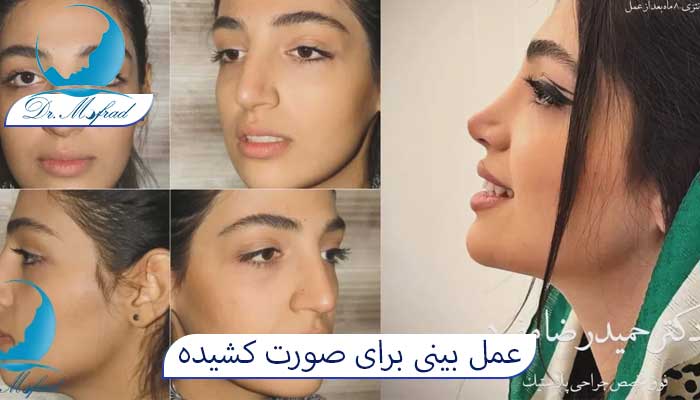 عمل بینی برای صورت کشیده