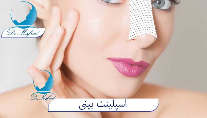 اسپلینت بینی