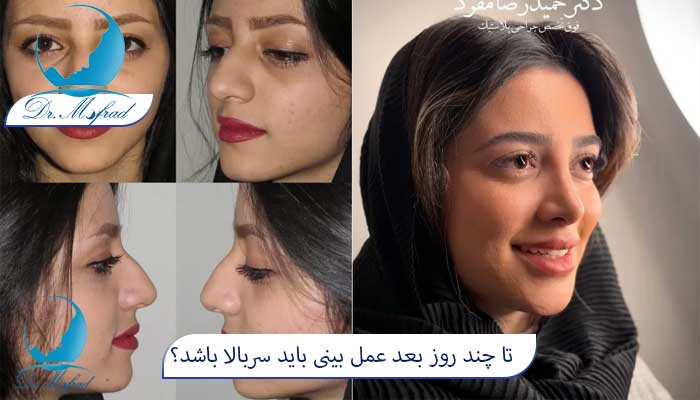 دوره نقاهت عمل بینی چقدر است؟