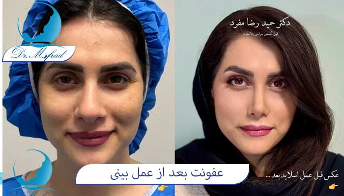 چه زمانی بعد از عمل، احتمال عفونت وجود دارد؟