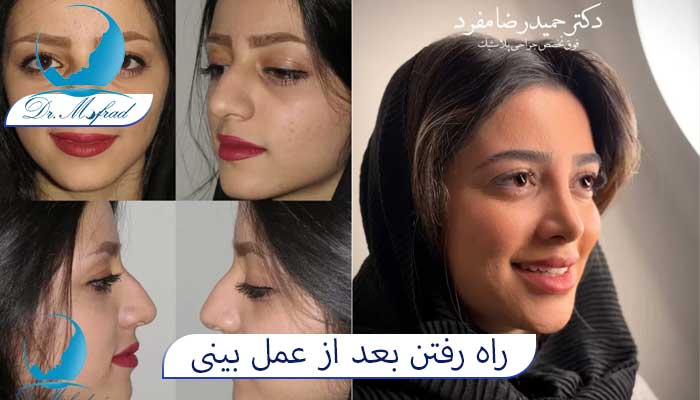 برای ورزش بعد از عمل بینی چه باید کرد؟