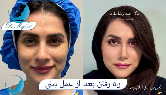 چند روز بعد از عمل بینی می‌توان راه رفت؟