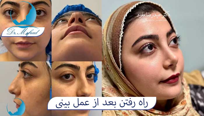 آیا راه رفتن بعد از عمل بینی درست است؟