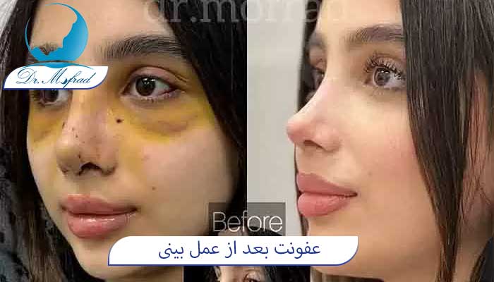 علت ایجاد عفونت بعد از عمل بینی