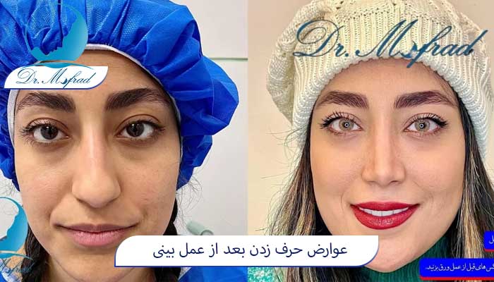 حرف زدن بعد از عمل بینی