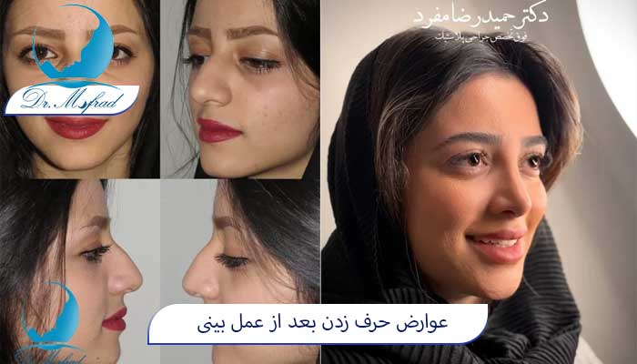 نحوی حرف زدن بعد از عمل بینی