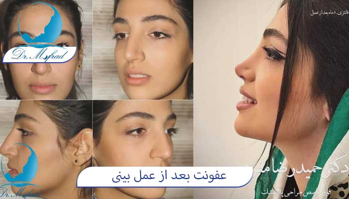 علائم عفونت بینی بعد از عمل زیبایی چیست؟