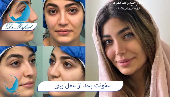 برای جلوگیری از عفونت بینی پس از جراحی چکار باید کرد؟