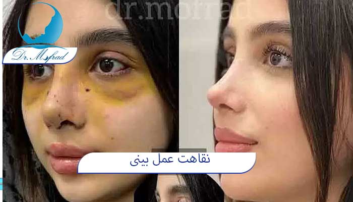 نقاهت عمل بینی 