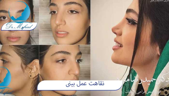 نقاهت پس از عمل جراحی بینی
