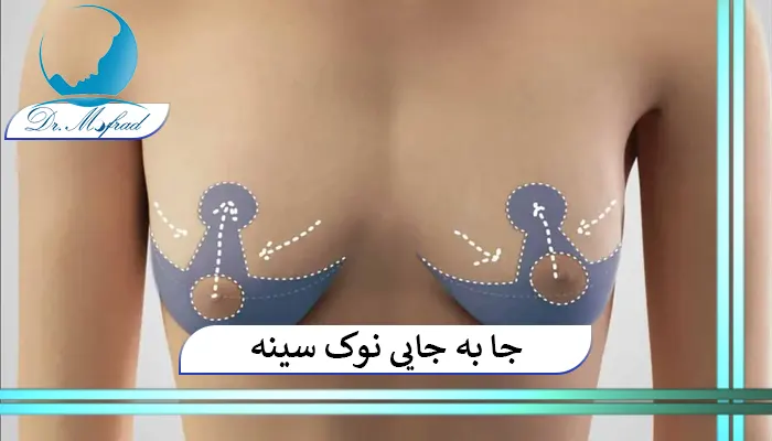 جا به جایی نوک سینه