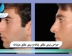 جراحی بینی عقابی زنانه و بینی عقابی مردانه