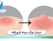 درمان نوک سینه فرورفته،روش های درمان نیپل فرو رفته