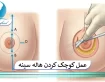 عمل کوچک کردن هاله سینه