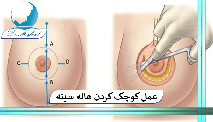 عمل کوچک کردن هاله سینه