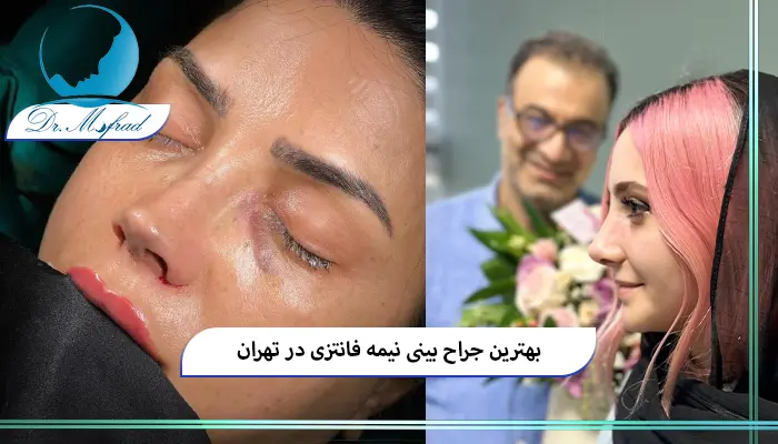 جراحی بینی نیمه فانتزی در تهران