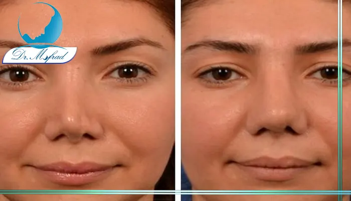 جراحی بینی ترمیمی