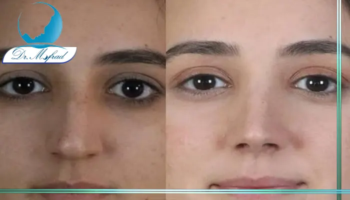 عمل ترمیمی افتادگی نوک بینی