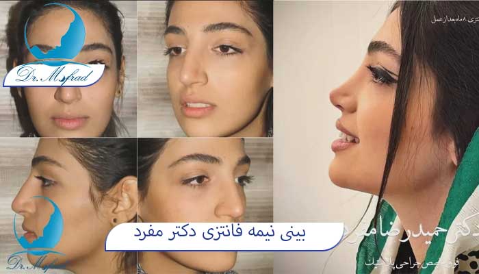 بهترین جراحی بینی نیمه فانتزی در تهران