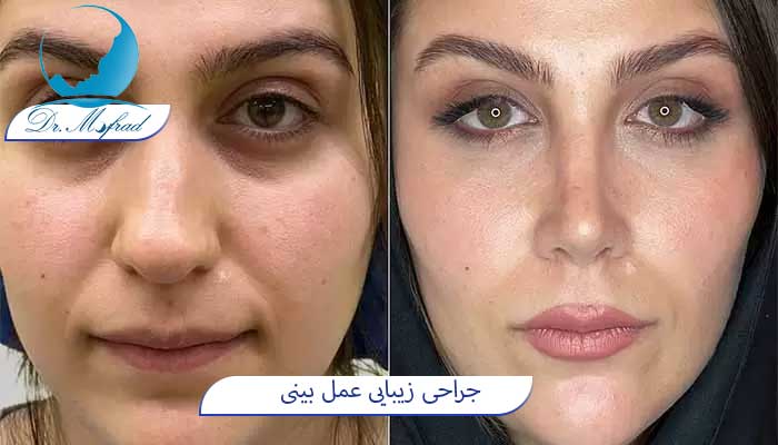 بهترین جراح بینی گوشتی