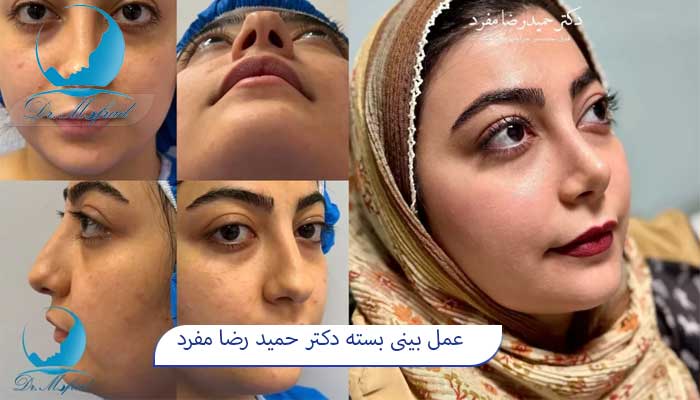 بهترین جراح عمل بینی بسته