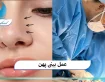 عمل بینی پهن
