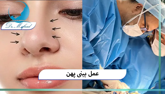 ویژگی‌های ظاهری بینی پهن