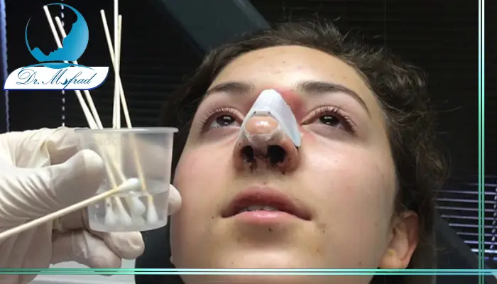 مزایای شست وشوی بینی بعد از عمل