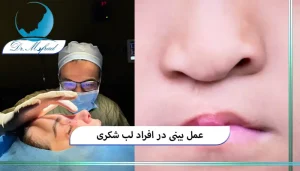 مراحل جراحی بینی در افرادی با شکاف لب