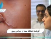 گوشت اضافه بعد از جراحی بینی