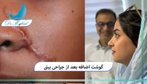 علت ایجاد گوشت اضافه بعد از جراحی بینی