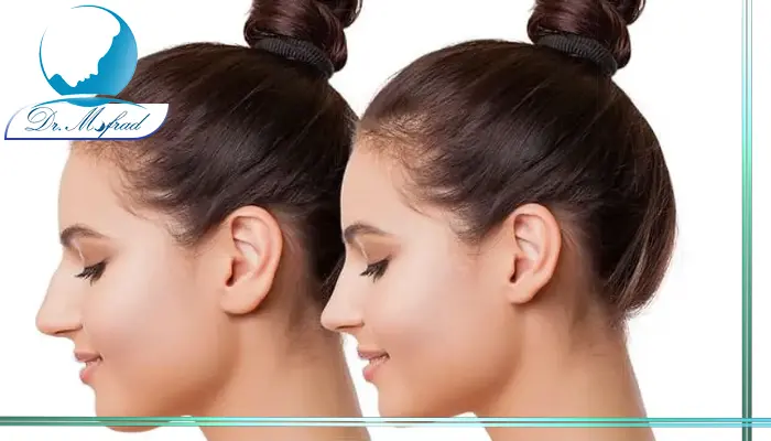 عمل بینی در نوجوانی