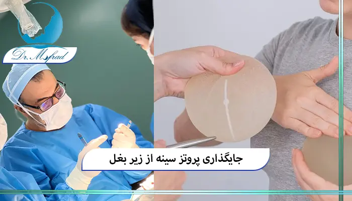 انتخاب نوع پروتز در روش زیر بغل