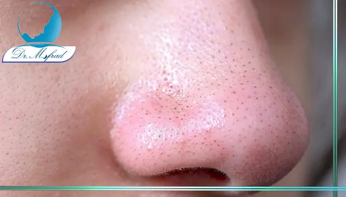 اهمیت پوست در جراحی بینی