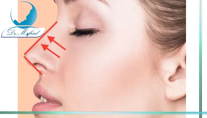 عمل بزرگ کردن بینی