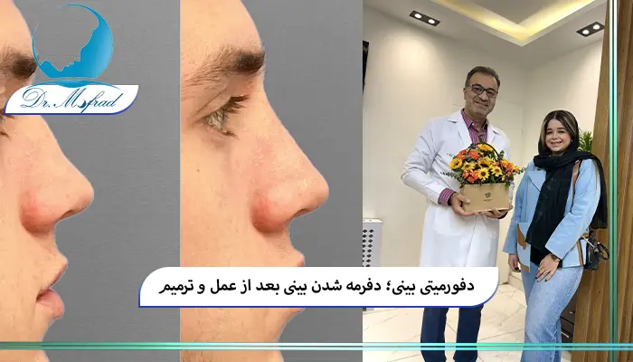 دلایل دفرمه شدن بینی بعد از عمل