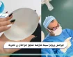 چرخش پروتز سینه عارضه شایع جراحان بی ‌تجربه