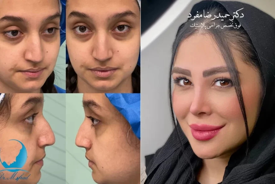 آنتی‌بیوتیک‌های تجویزی بعد عمل بینی: دوره مصرف و اهمیت کامل کردن