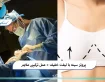 پروتز سینه با لیفت خفیف + عمل ترکیبی ملایم