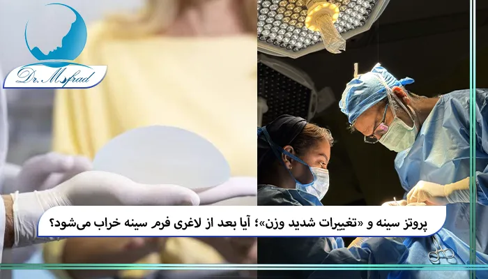چرا کاهش وزن شدید روی فرم سینه بعد از پروتز اثر میگذارد؟